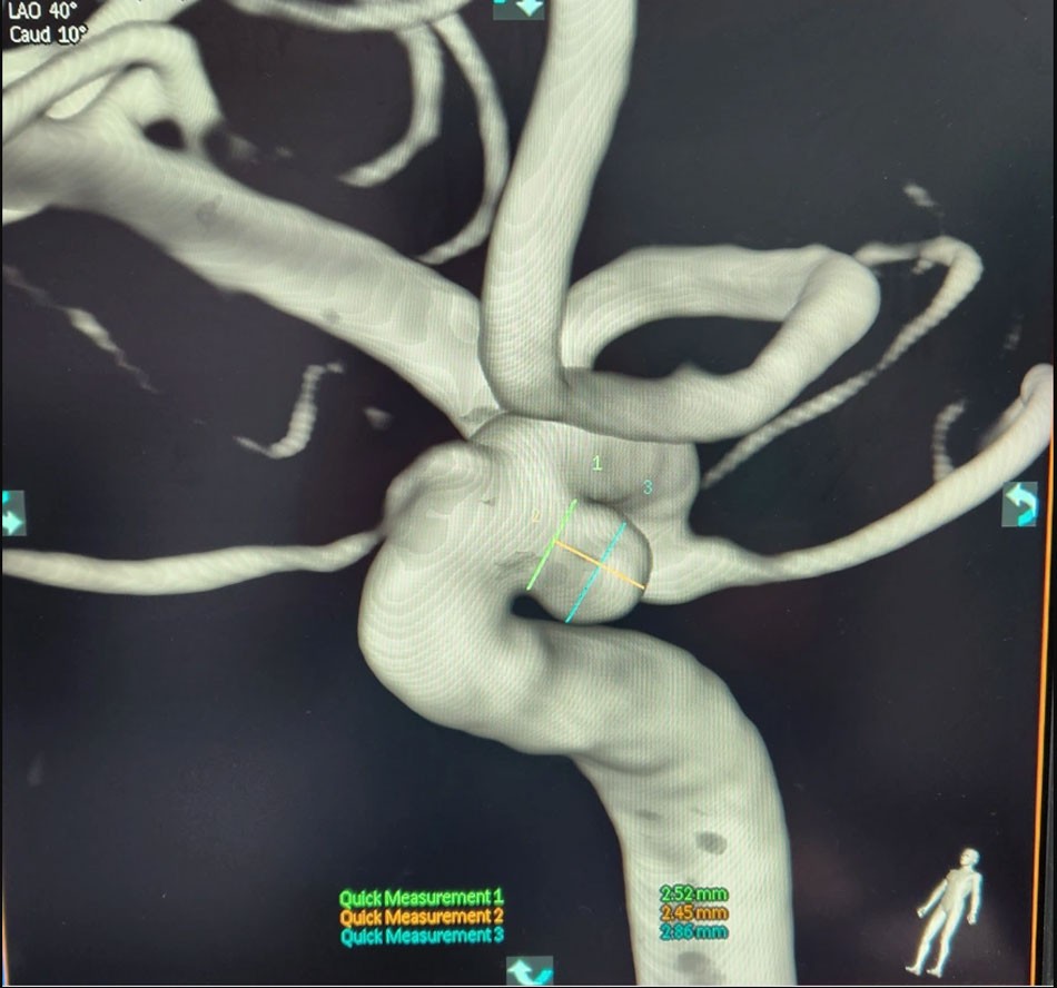 brain-aneurysms-can-be-treated-with-endovascular-intervention-1696238883.jpeg