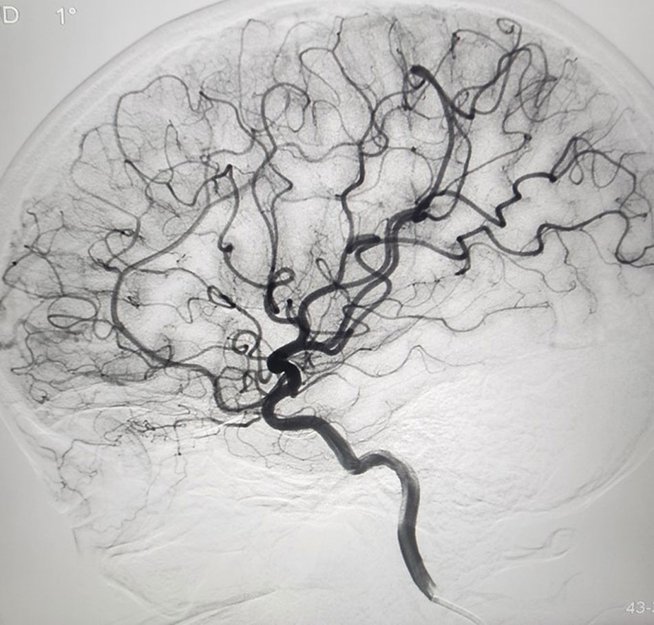brain-aneurysms-can-be-treated-with-endovascular-intervention-3-1696238883.jpeg