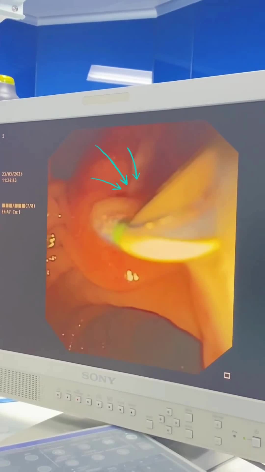 dich-mu-chay-ao-at-trong-qua-trinh-ercp-pld-1752189152.mp4